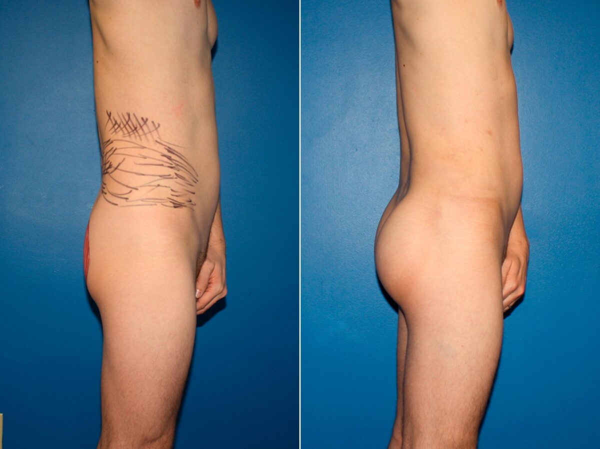 Gluteal Augmentation Before and After Photos in New York, NY, Patient 14207
