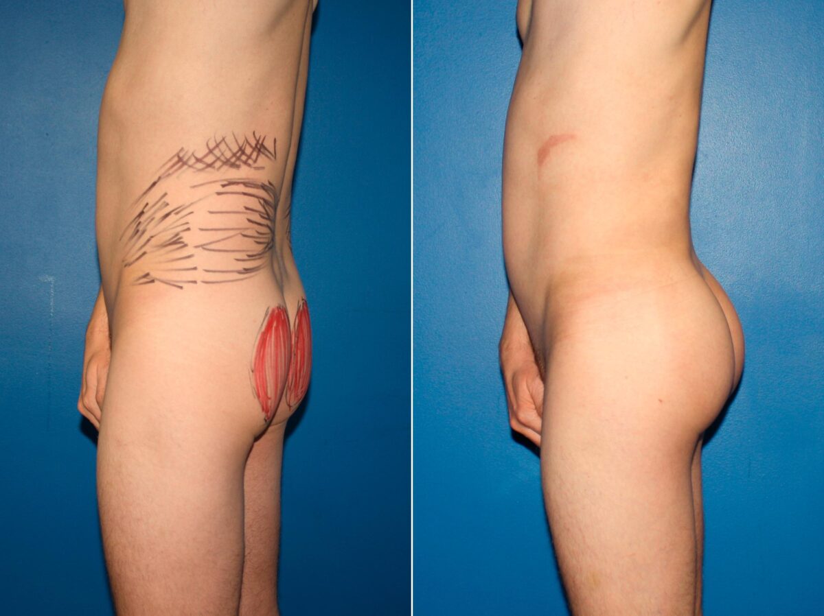 Gluteal Augmentation Before and After Photos in New York, NY, Patient 14207