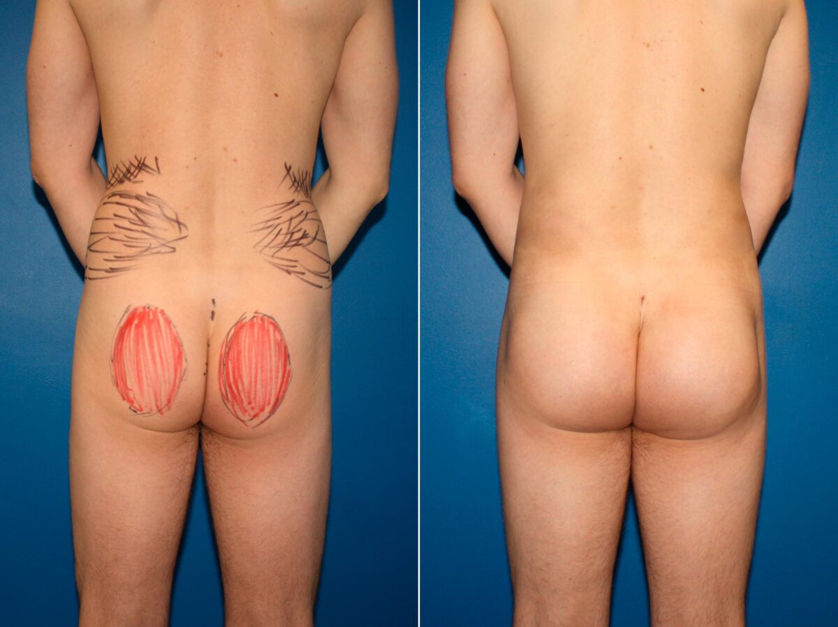 Gluteal Augmentation Before and After Photos in New York, NY, Patient 14207