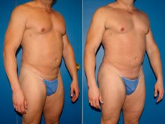 Gluteal Augmentation Before and After Photos in New York, NY, Patient 14223