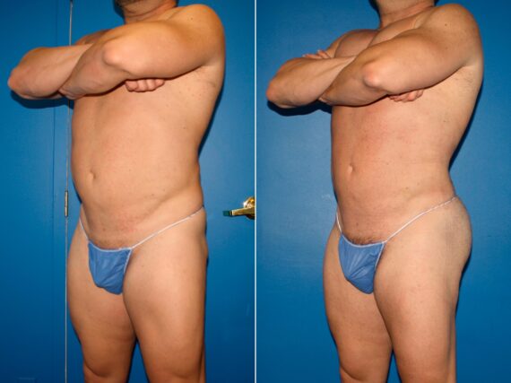 Gluteal Augmentation Before and After Photos in New York, NY, Patient 14223