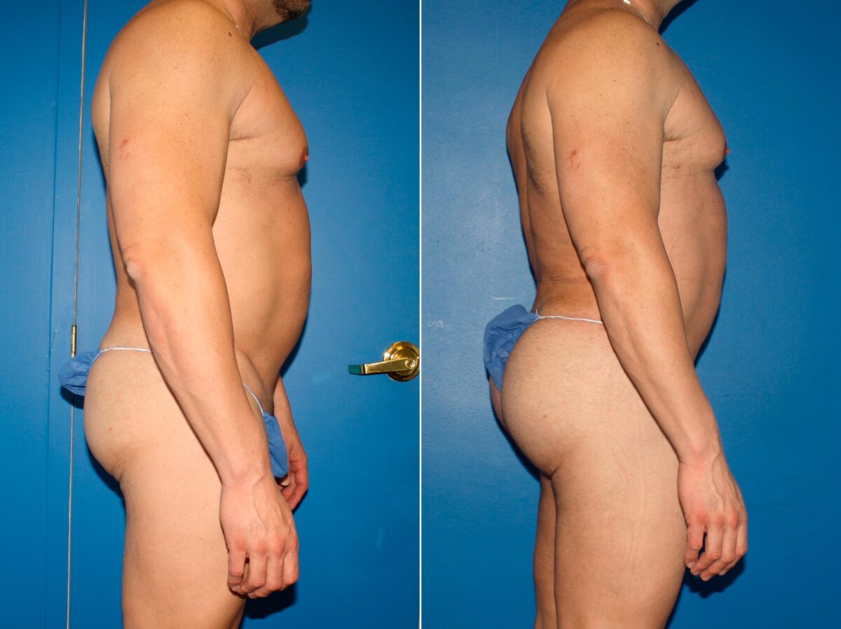Gluteal Augmentation Before and After Photos in New York, NY, Patient 14223
