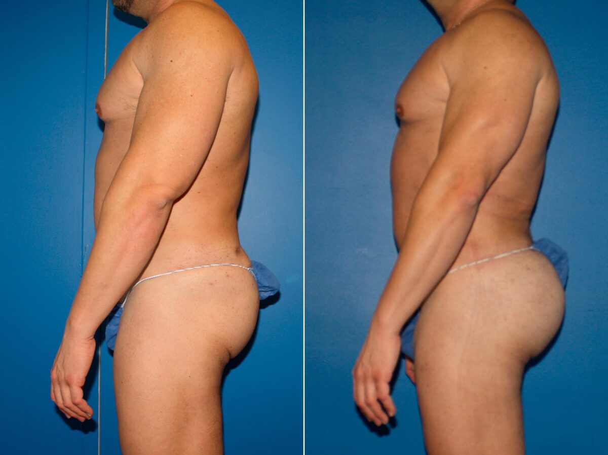 Gluteal Augmentation Before and After Photos in New York, NY, Patient 14223