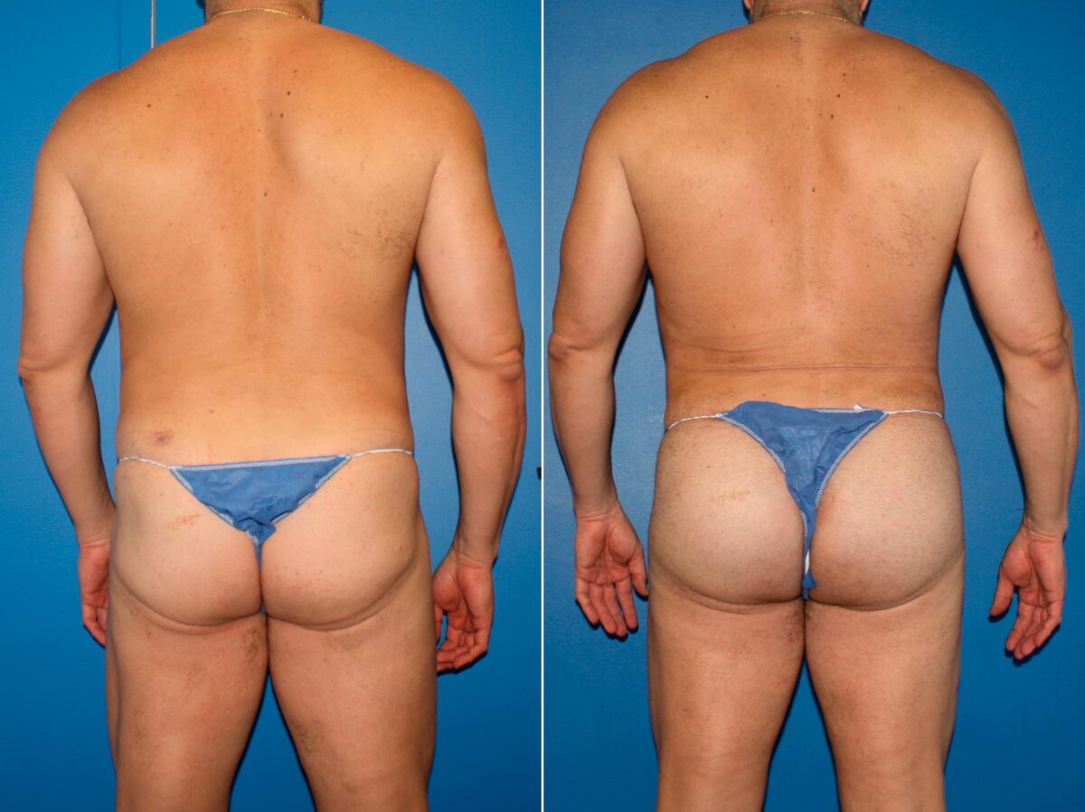 Gluteal Augmentation Before and After Photos in New York, NY, Patient 14223