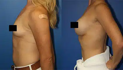 Liposuction Patient 1 | Lateral Left Before and After | Dr. Steinbrech | New York