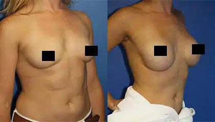 Liposuction Patient 1 | Oblique Right Before and After | Dr. Steinbrech | New York