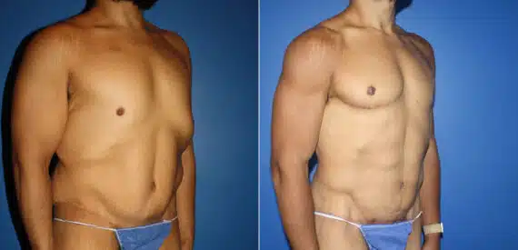 Hi-Def Liposuction Before and After Photos in New York, NY, Patient 14612