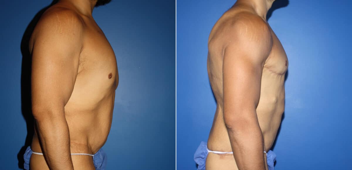 Torso Tuck Before and After Photos in New York, NY, Patient 14612