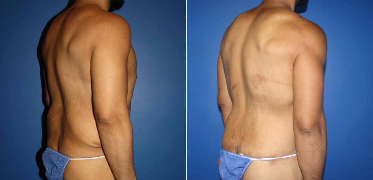 Torso Tuck Before and After Photos in New York, NY, Patient 14612