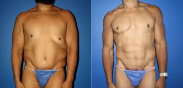 Hi-Def Liposuction Before and After Photos in New York, NY, Patient 14612