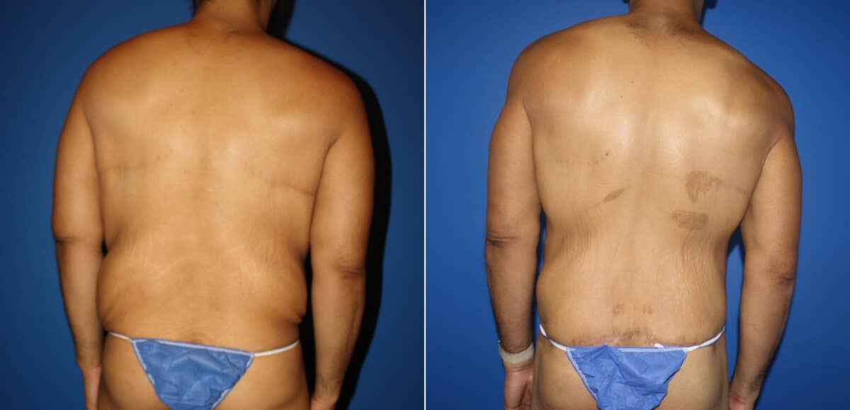 Torso Tuck Before and After Photos in New York, NY, Patient 14612