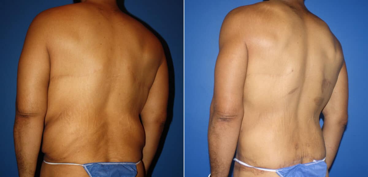 Torso Tuck Before and After Photos in New York, NY, Patient 14612