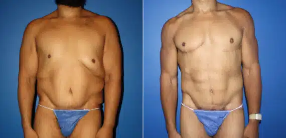 Hi-Def Liposuction Before and After Photos in New York, NY, Patient 14612
