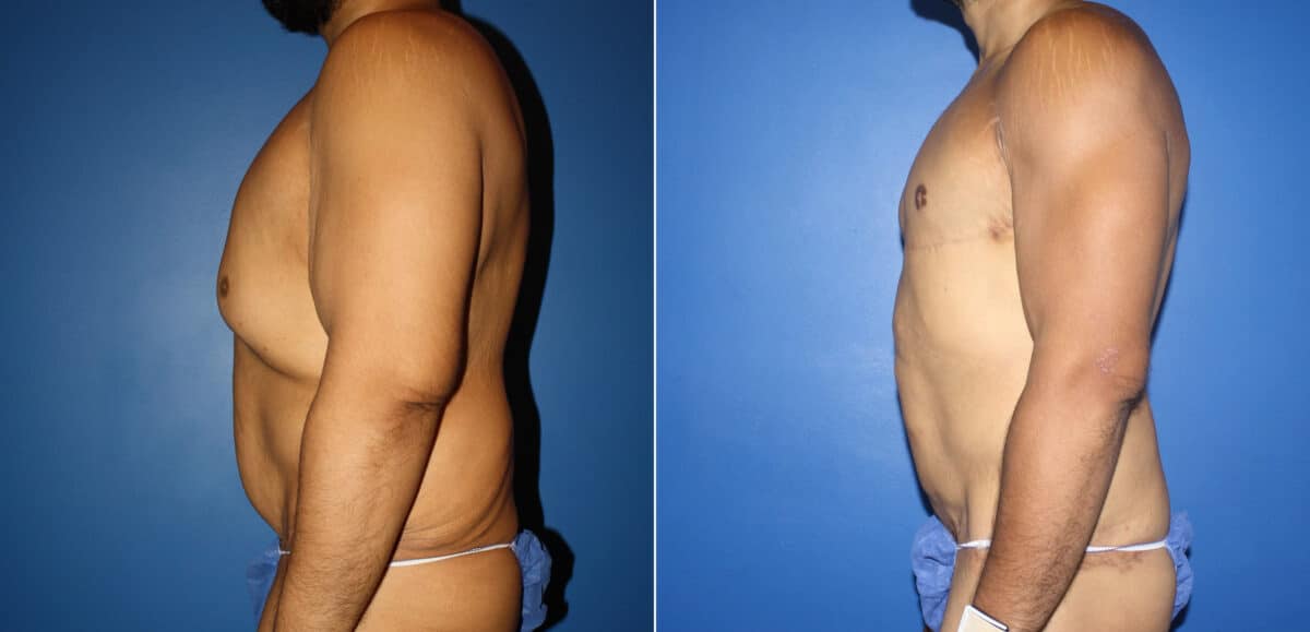 Torso Tuck Before and After Photos in New York, NY, Patient 14612