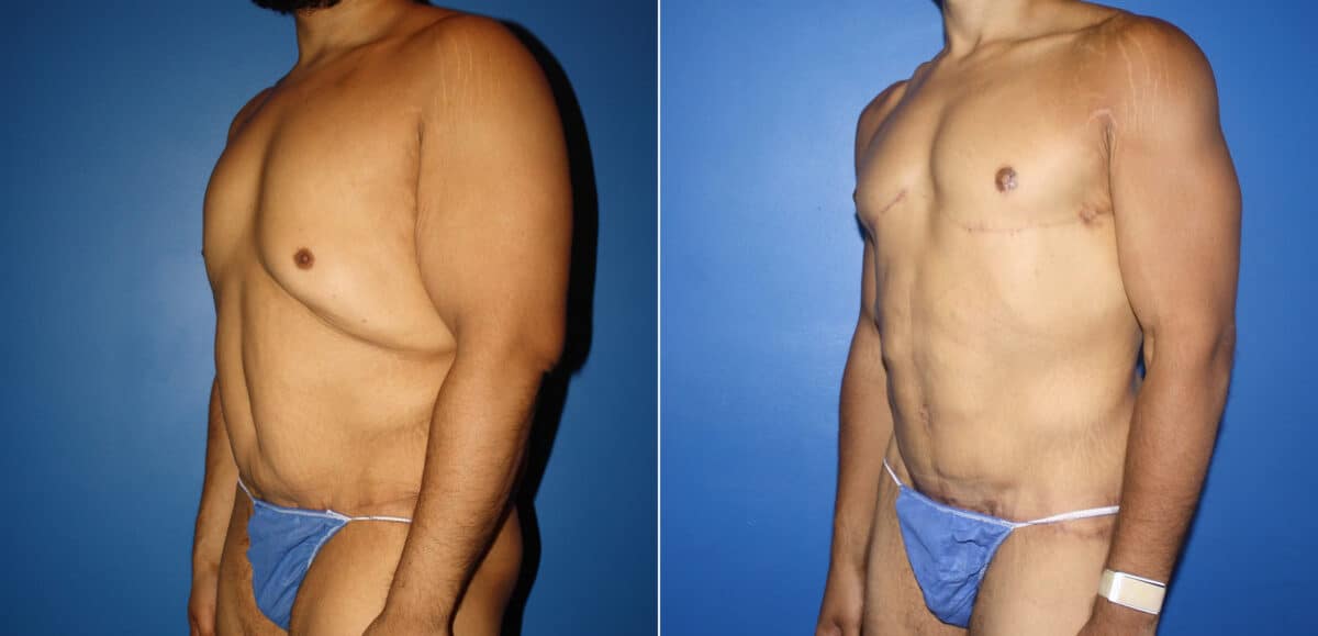 Torso Tuck Before and After Photos in New York, NY, Patient 14612