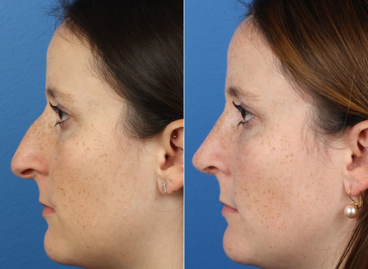 Patient 14864, Rhinoplasty Before and After Photos Rhinoplasty Before and After Photos in New York, NY, Patient 14864