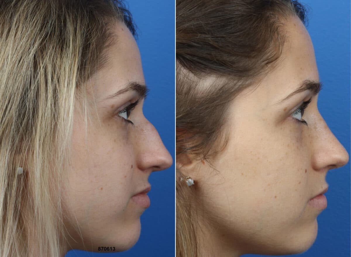 Patient 14880, Rhinoplasty Before and After Photos Rhinoplasty Before and After Photos in New York, NY, Patient 14880