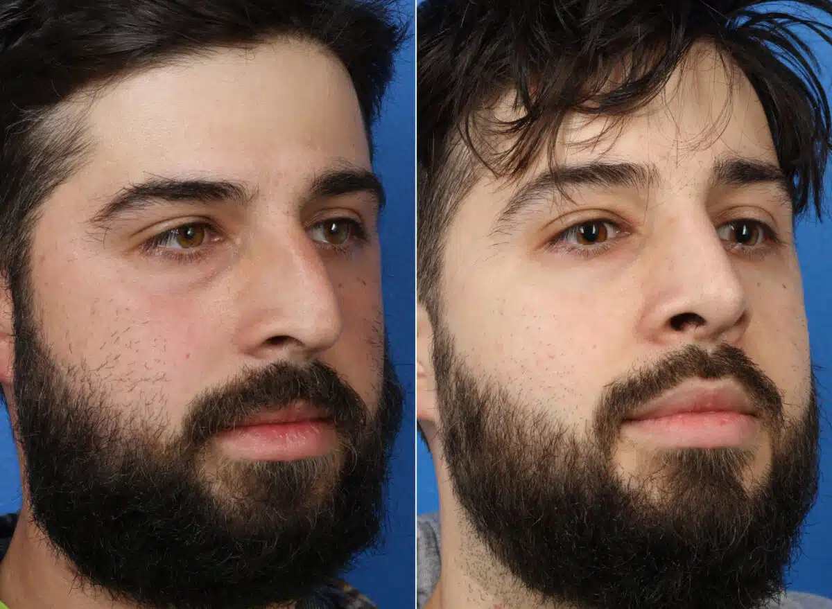 Patient 14890, Rhinoplasty Before and After Photos Rhinoplasty Before and After Photos in New York, NY, Patient 14890