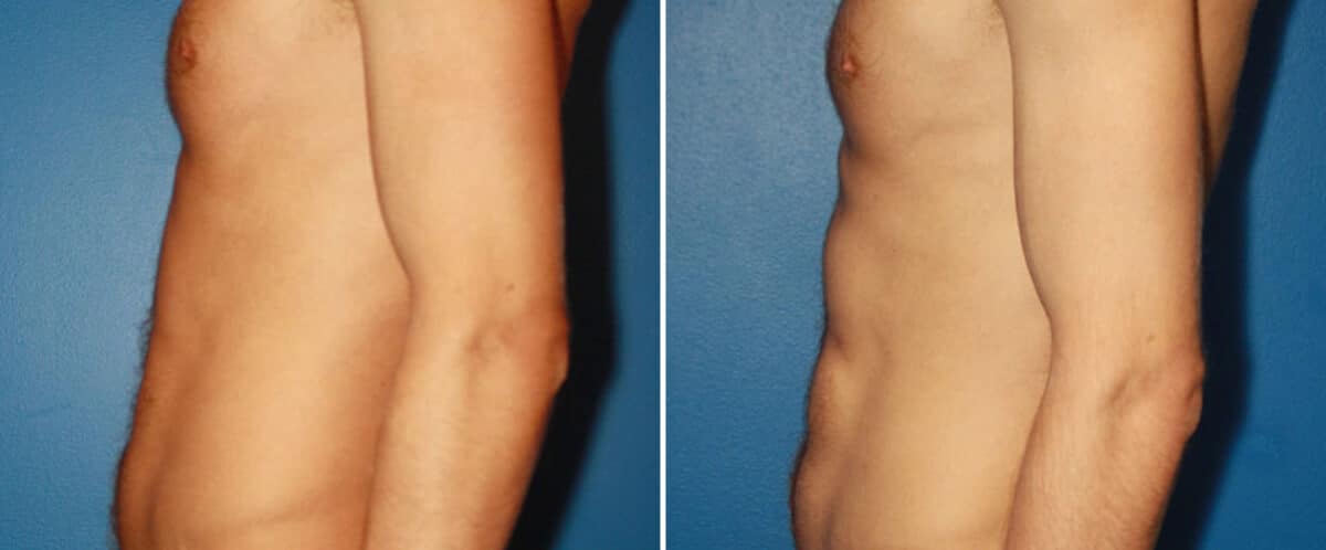 Abdominal Implants Before and After Photos in New York, NY, Patient 15676