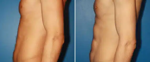 Abdominal Implants Before and After Photos in New York, NY, Patient 15676