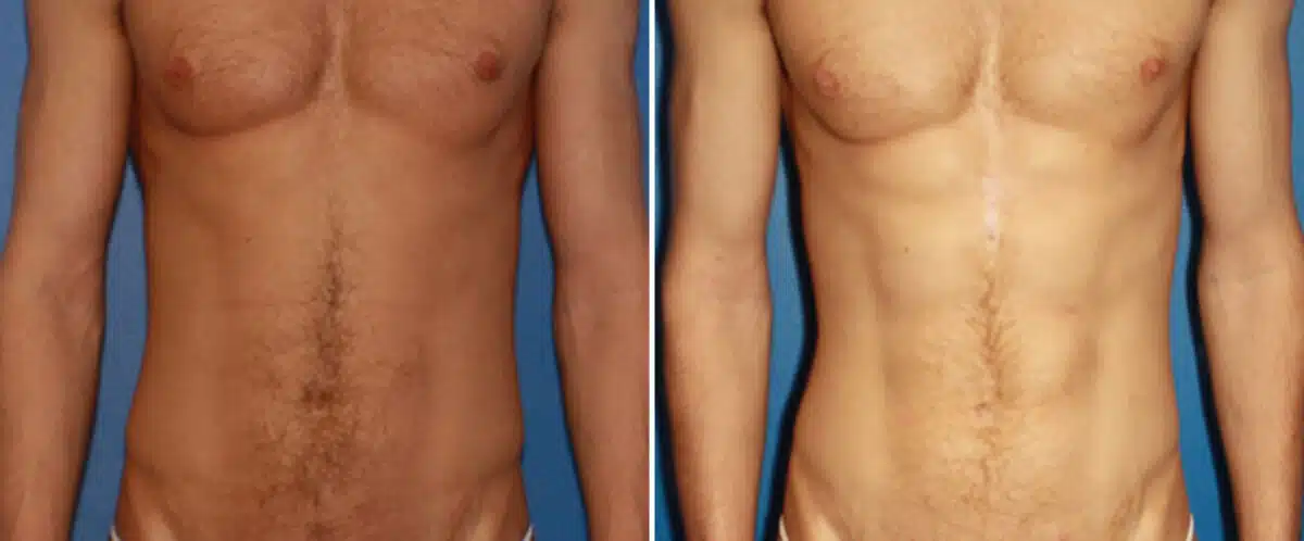 Abdominal Implants Before and After Photos in New York, NY, Patient 15676