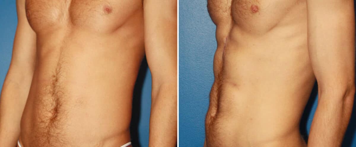 Abdominal Implants Before and After Photos in New York, NY, Patient 15676