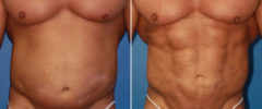 Abdominal Implants Before and After Photos in New York, NY, Patient 15689