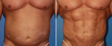 Abdominal Implants Before and After Photos in New York, NY, Patient 15689