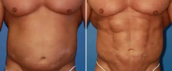 Abdominal Implants Before and After Photos in New York, NY, Patient 15689