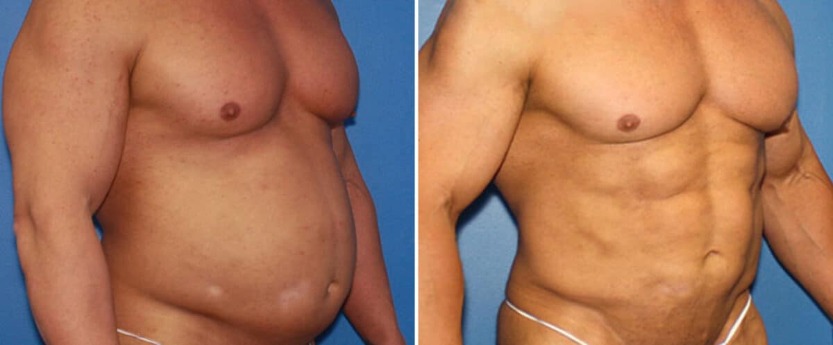 Abdominal Implants Before and After Photos in New York, NY, Patient 15689