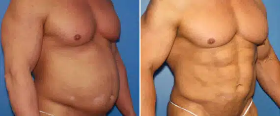 Abdominal Implants Before and After Photos in New York, NY, Patient 15689