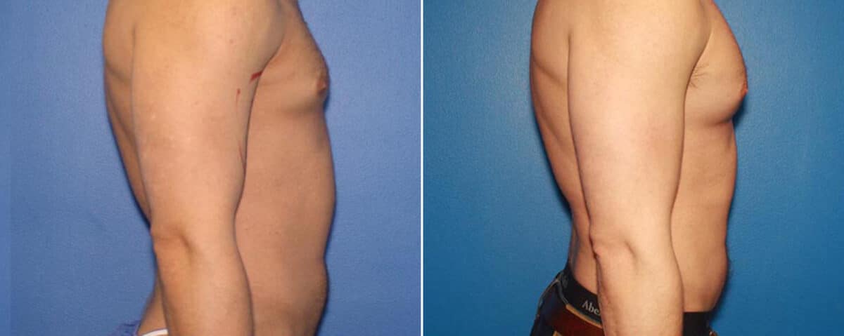 Biceps And Triceps Implants Before and After Photos in New York, NY, Patient 15776