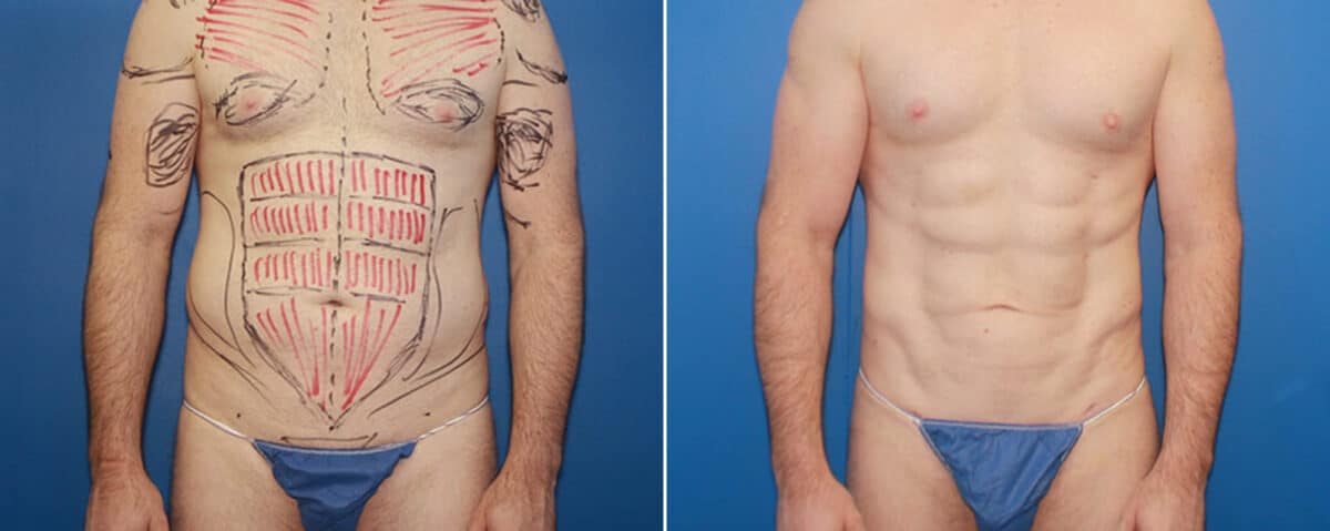 Body Banking Before and After Photos in New York, NY, Patient 15818