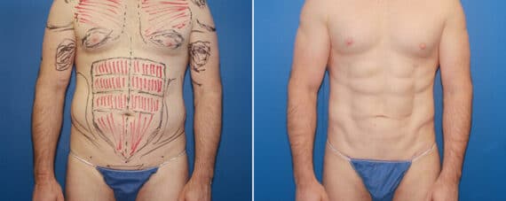 Biceps And Triceps Implants Before and After Photos in New York, NY, Patient 15818