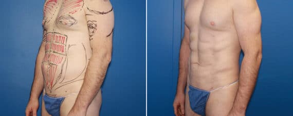 Biceps And Triceps Implants Before and After Photos in New York, NY, Patient 15818