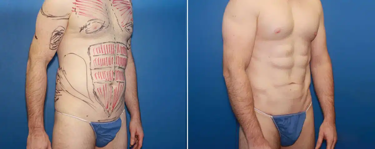 Biceps And Triceps Implants Before and After Photos in New York, NY, Patient 15818