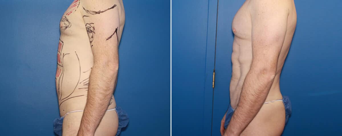 Biceps And Triceps Implants Before and After Photos in New York, NY, Patient 15818