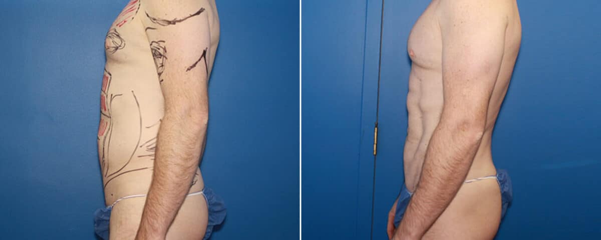 Body Banking Before and After Photos in New York, NY, Patient 15818