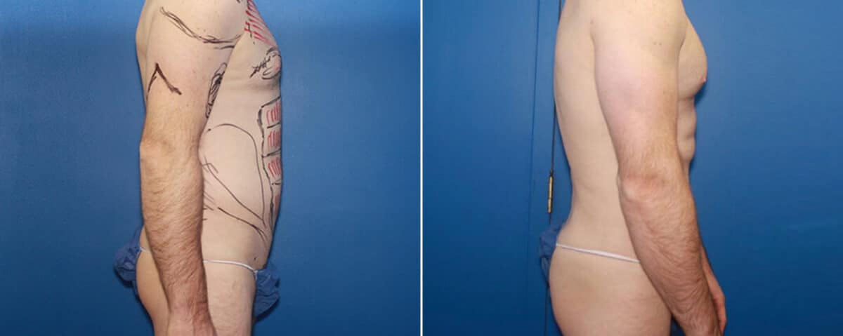 Biceps And Triceps Implants Before and After Photos in New York, NY, Patient 15818