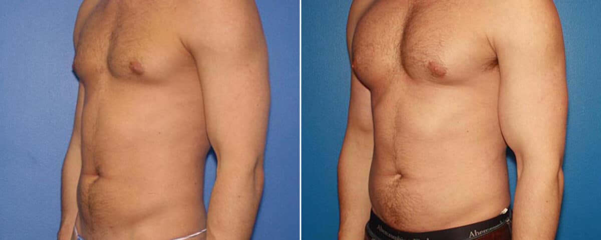 Biceps And Triceps Implants Before and After Photos in New York, NY, Patient 15776