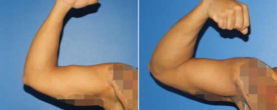 Biceps And Triceps Implants Before and After Photos in New York, NY, Patient 15841