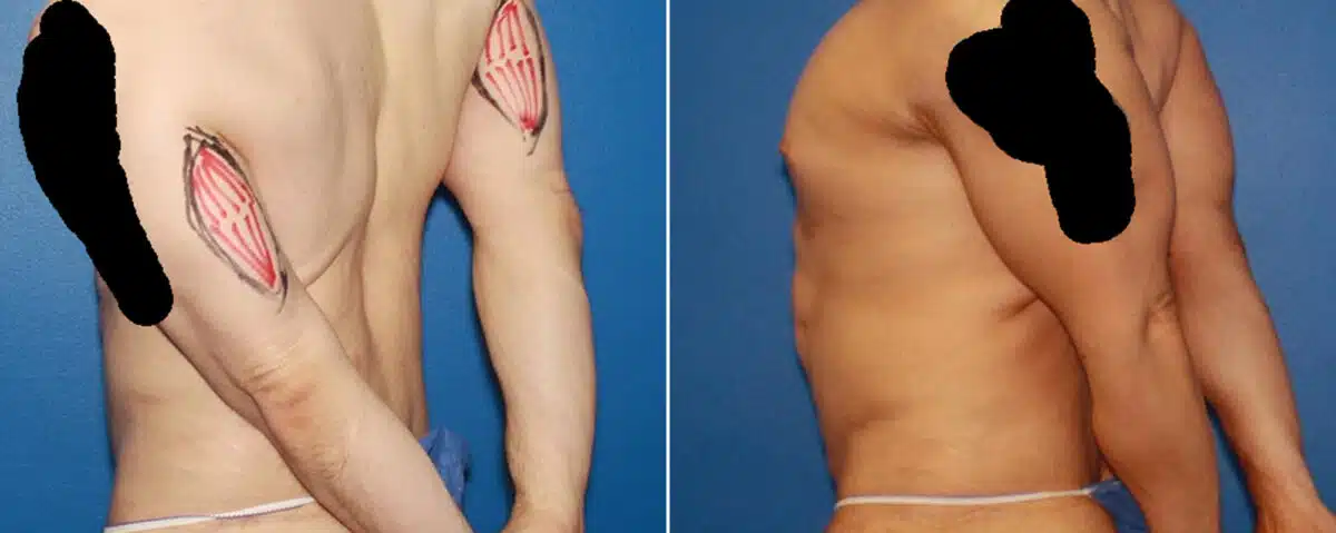 Biceps And Triceps Implants Before and After Photos in New York, NY, Patient 15848