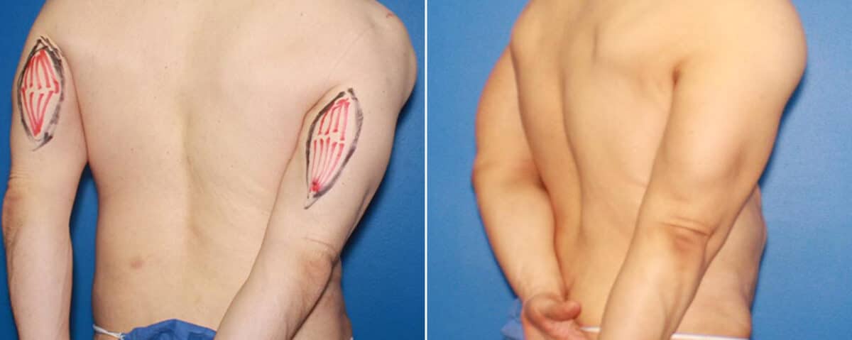 Biceps And Triceps Implants Before and After Photos in New York, NY, Patient 15848