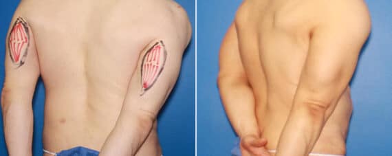 Biceps And Triceps Implants Before and After Photos in New York, NY, Patient 15848