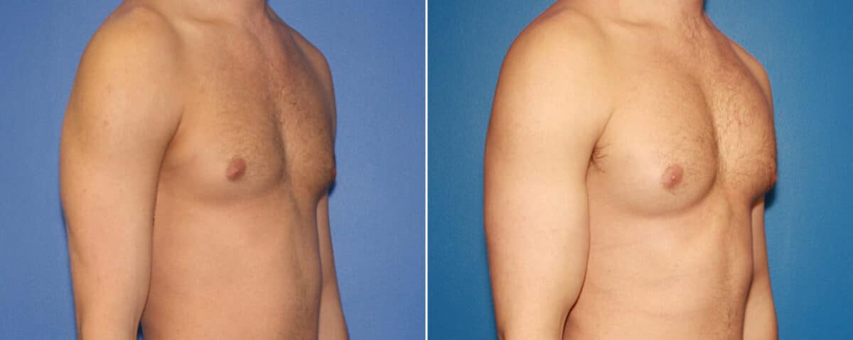 Biceps And Triceps Implants Before and After Photos in New York, NY, Patient 15776