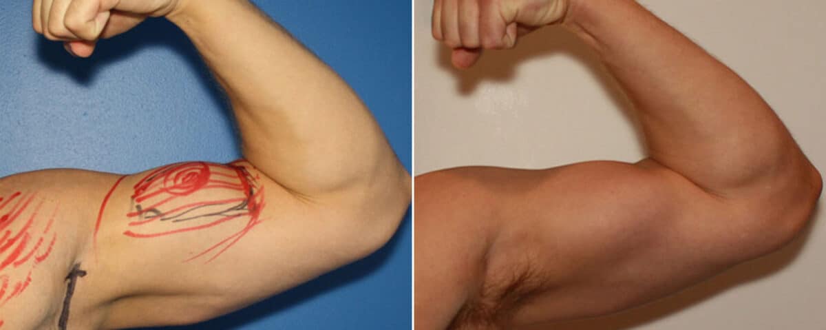 Biceps And Triceps Implants Before and After Photos in New York, NY, Patient 15776