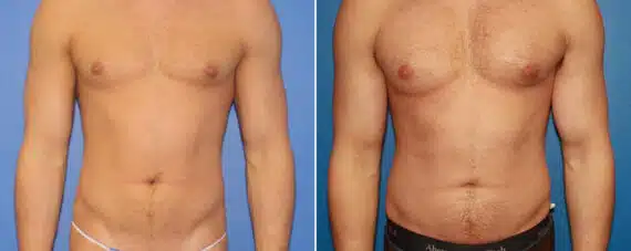 Biceps And Triceps Implants Before and After Photos in New York, NY, Patient 15776