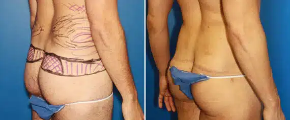 Body Lift Before and After Photos in New York, NY, Patient 15744