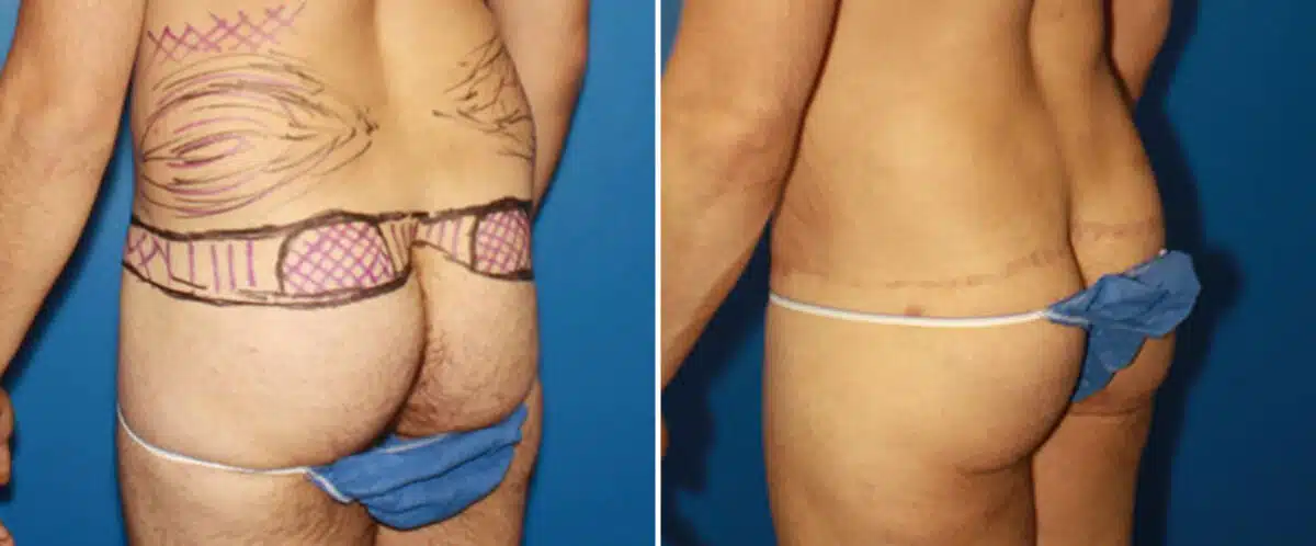 Body Lift Before and After Photos in New York, NY, Patient 15744