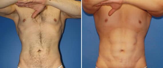 Body Lift Before and After Photos in New York, NY, Patient 15751